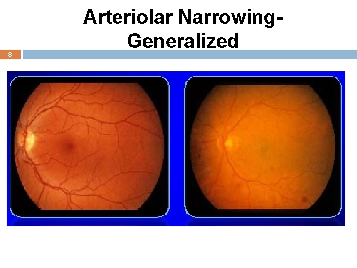 8 Arteriolar Narrowing. Generalized 