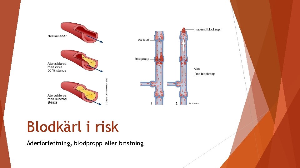 Blodkärl i risk Åderförfettning, blodpropp eller bristning 