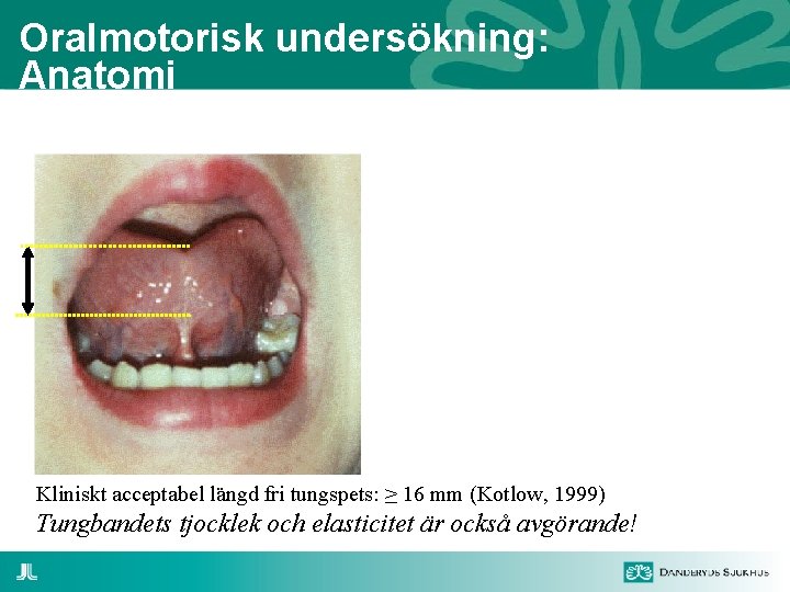 Oralmotorisk undersökning: Anatomi Kliniskt acceptabel längd fri tungspets: ≥ 16 mm (Kotlow, 1999) Tungbandets