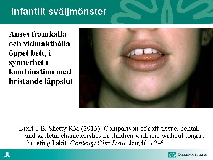 Infantilt sväljmönster Anses framkalla och vidmakthålla öppet bett, i synnerhet i kombination med bristande