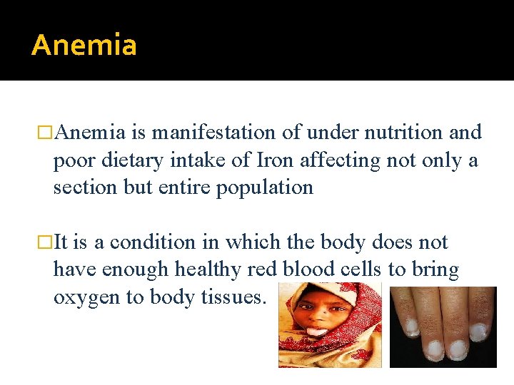 Anemia �Anemia is manifestation of under nutrition and poor dietary intake of Iron affecting