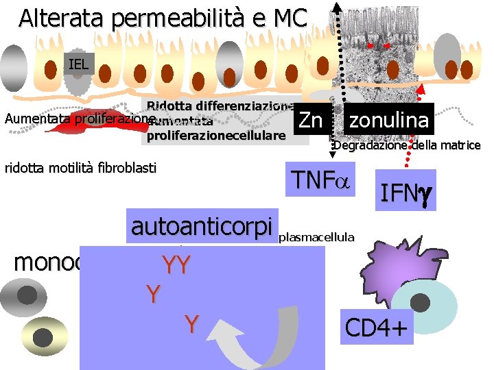 Alterata permeabilità e MC IEL Ridotta differenziazione Aumentata proliferazione aumentata proliferazionecellulare ridotta motilità fibroblasti