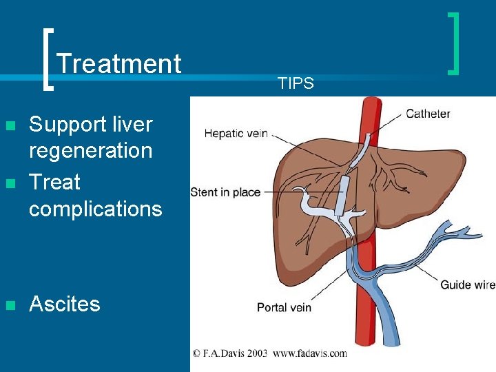 Treatment n n n Support liver regeneration Treat complications Ascites TIPS 