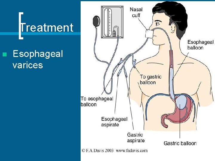  Treatment n Esophageal varices 