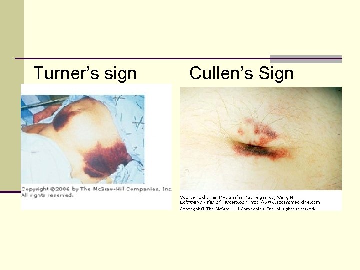 Turner’s sign Cullen’s Sign 