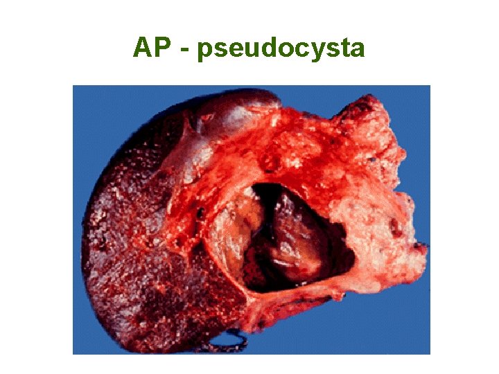 AP - pseudocysta 