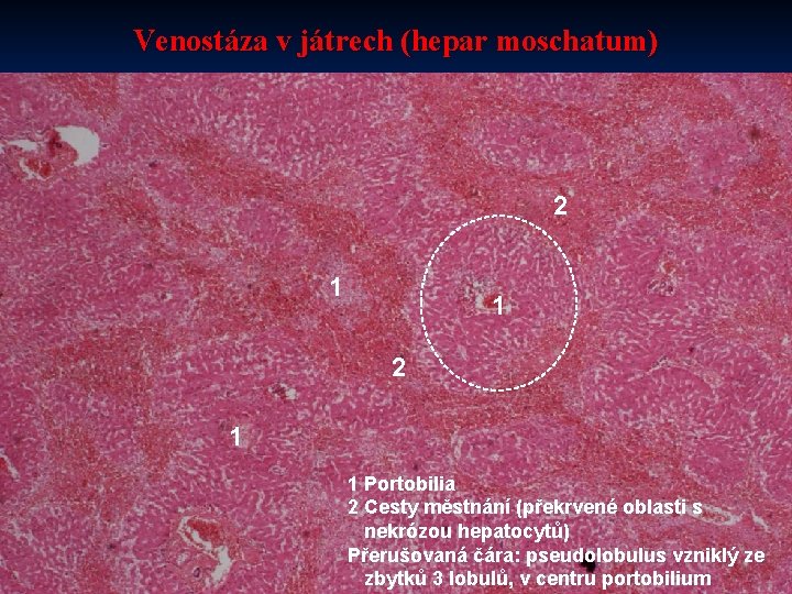 Venostáza v játrech (hepar moschatum) 2 1 1 Portobilia 2 Cesty městnání (překrvené oblasti