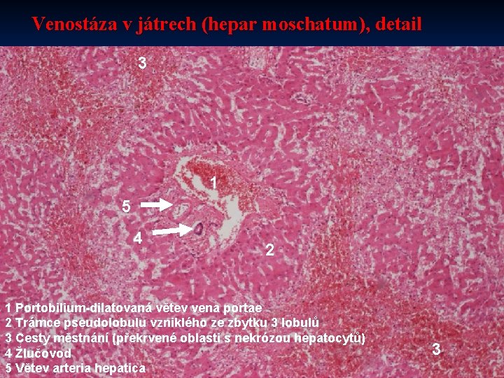 Venostáza v játrech (hepar moschatum), detail 3 1 5 4 2 1 Portobilium-dilatovaná větev