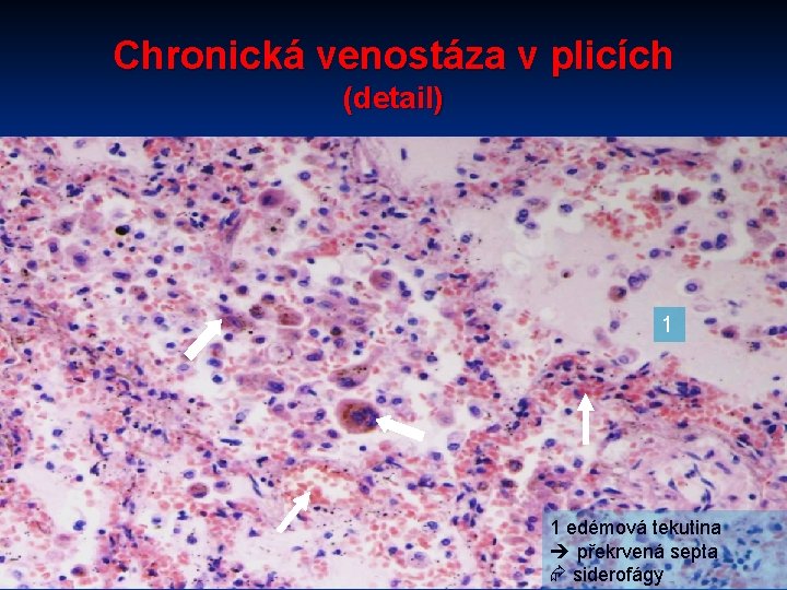 Chronická venostáza v plicích (detail) 1 1 edémová tekutina překrvená septa siderofágy 