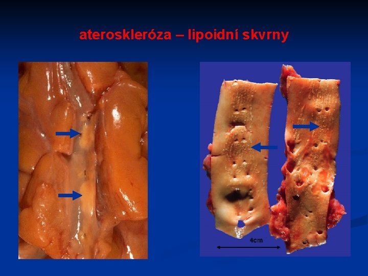 ateroskleróza – lipoidní skvrny 