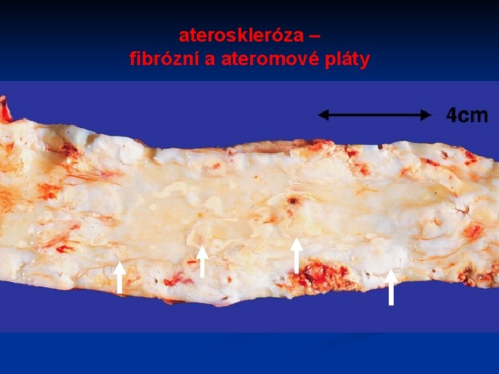 ateroskleróza – fibrózní a ateromové pláty 