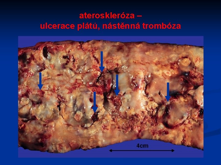 ateroskleróza – ulcerace plátů, nástěnná trombóza 