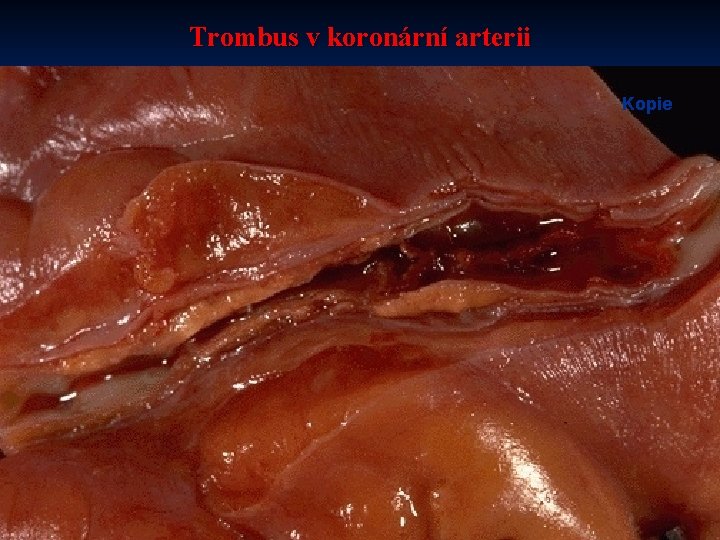 Trombus v koronární arterii Kopie 
