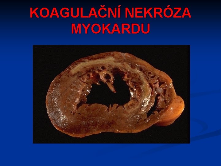 KOAGULAČNÍ NEKRÓZA MYOKARDU 