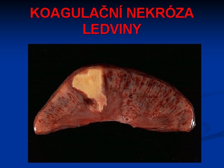 KOAGULAČNÍ NEKRÓZA LEDVINY 