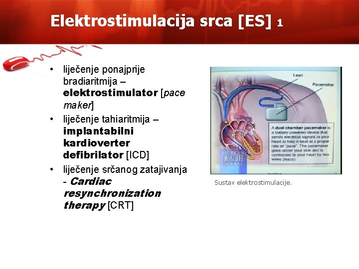 Elektrostimulacija srca [ES] • liječenje ponajprije bradiaritmija – elektrostimulator [pace maker] • liječenje tahiaritmija