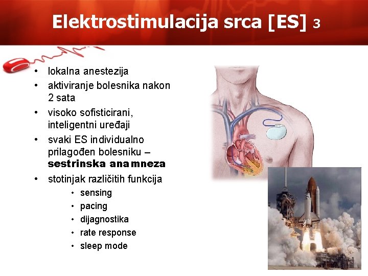 Elektrostimulacija srca [ES] • lokalna anestezija • aktiviranje bolesnika nakon 2 sata • visoko