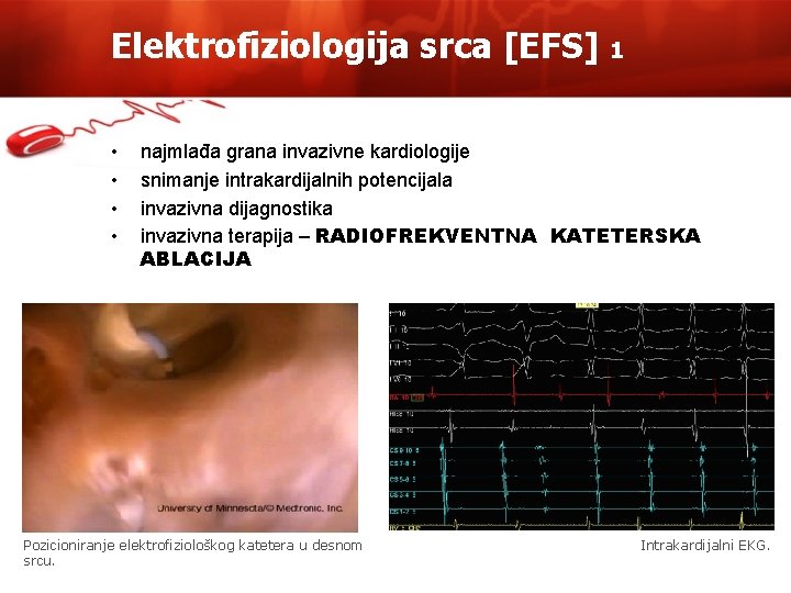 Elektrofiziologija srca [EFS] • • 1 najmlađa grana invazivne kardiologije snimanje intrakardijalnih potencijala invazivna