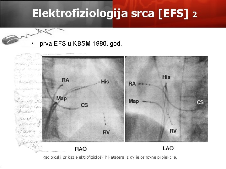 Elektrofiziologija srca [EFS] • prva EFS u KBSM 1980. god. Radiološki prikaz elektrofizioloških katetera
