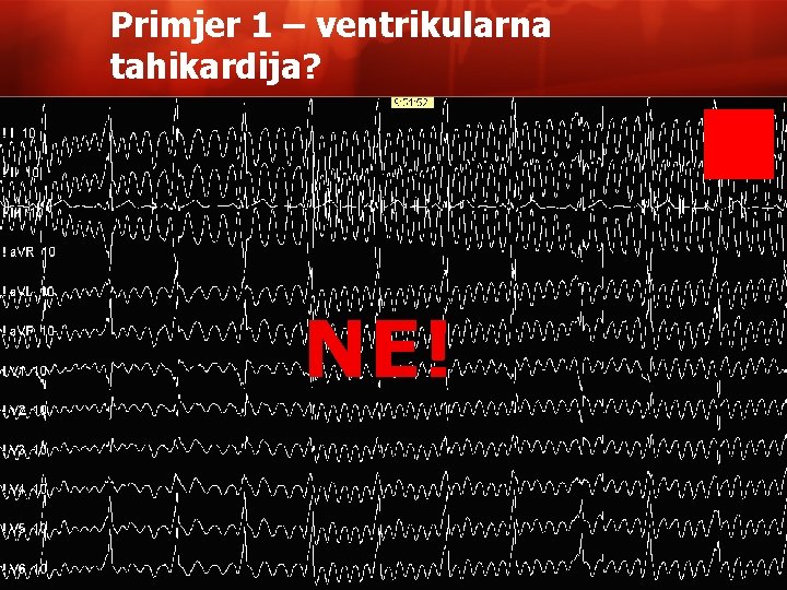 Primjer 1 – ventrikularna tahikardija? NE! 