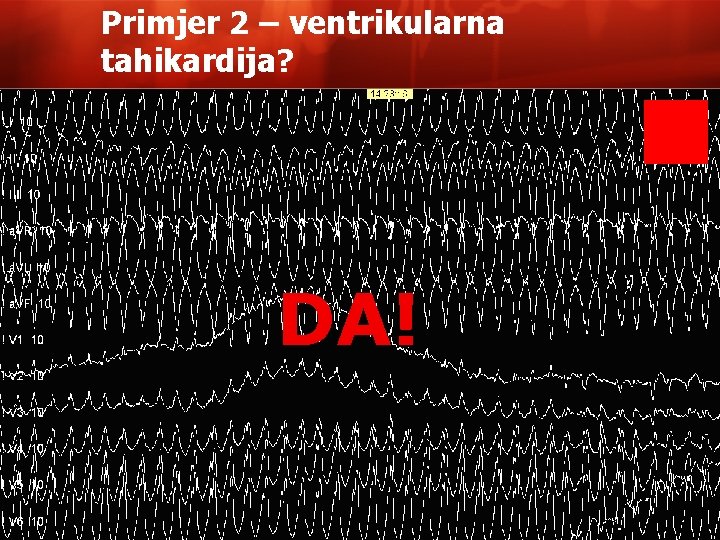 Primjer 2 – ventrikularna tahikardija? DA! 