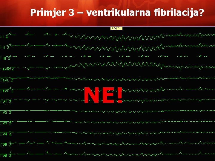 Primjer 3 – ventrikularna fibrilacija? NE! 