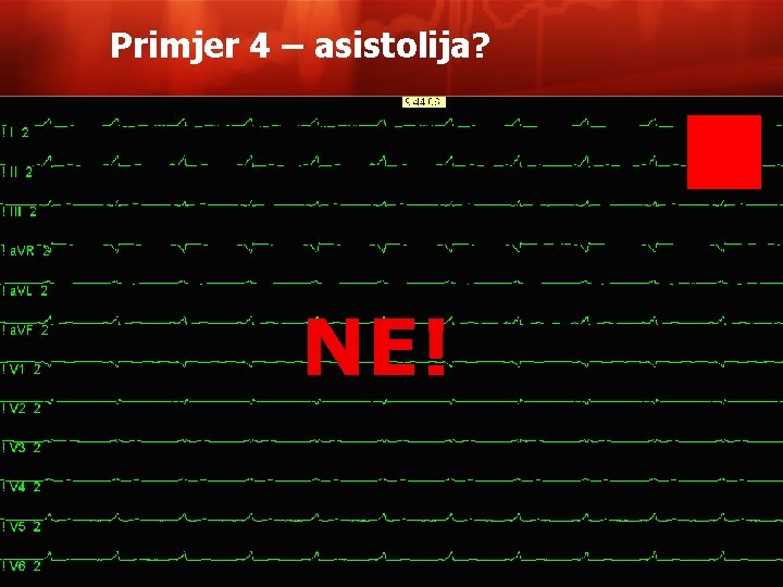 Primjer 4 – asistolija? NE! 