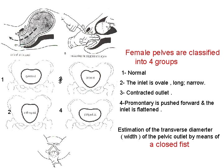 Female pelves are classified into 4 groups 3 33 1 1 - Normal 2