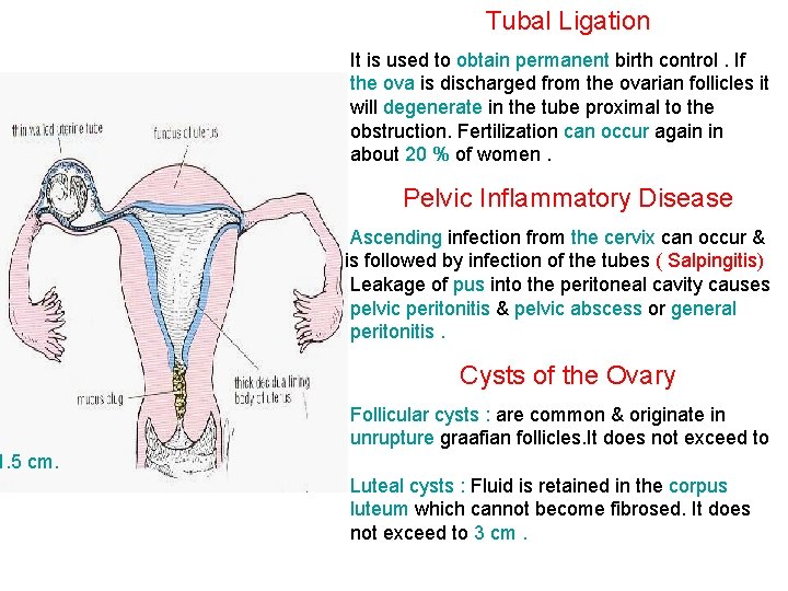 Tubal Ligation It is used to obtain permanent birth control. If the ova is