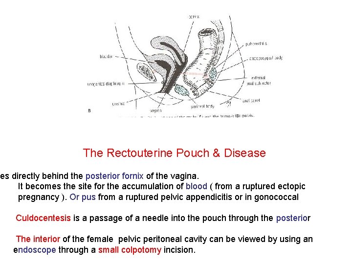 The Rectouterine Pouch & Disease ies directly behind the posterior fornix of the vagina.