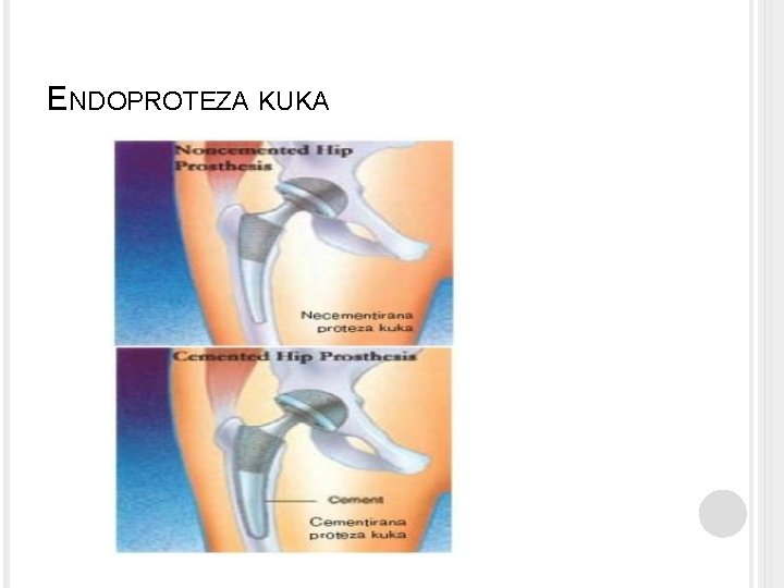 ENDOPROTEZA KUKA 