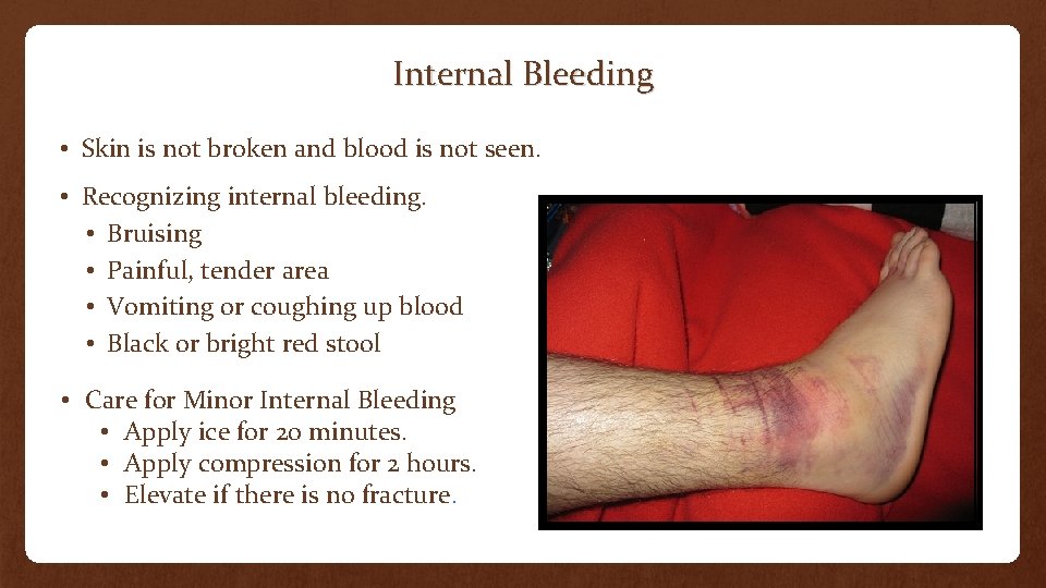 Internal Bleeding • Skin is not broken and blood is not seen. • Recognizing