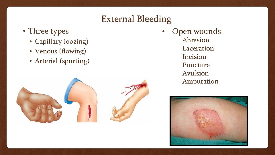 External Bleeding • Three types • Capillary (oozing) • Venous (flowing) • Arterial (spurting)