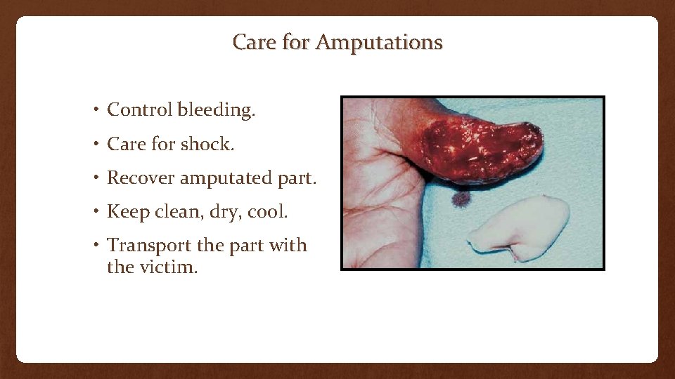 Care for Amputations • Control bleeding. • Care for shock. • Recover amputated part.