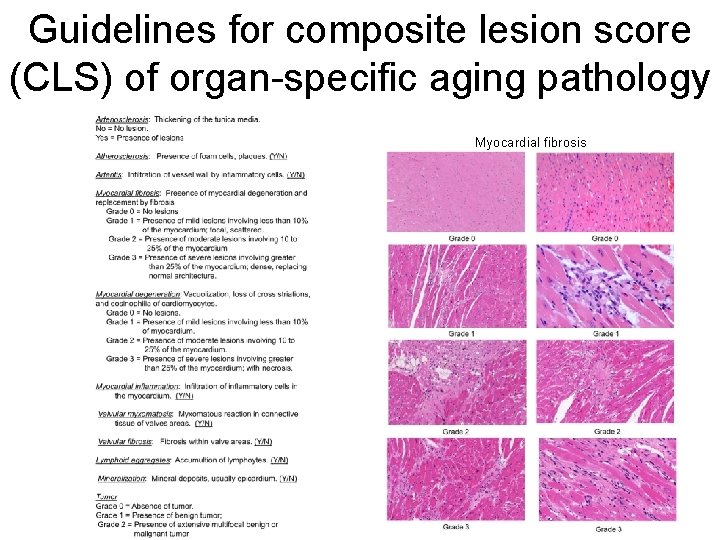 Guidelines for composite lesion score (CLS) of organ-specific aging pathology Myocardial fibrosis 