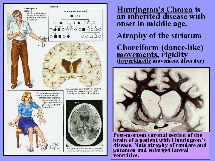 Huntington’s Chorea is an inherited disease with onset in middle age. Atrophy of the