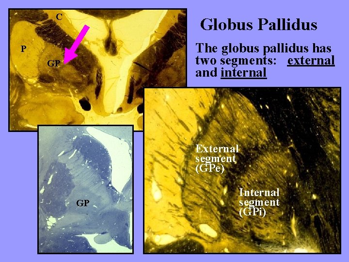 C Globus Pallidus The globus pallidus has two segments: external and internal P GP