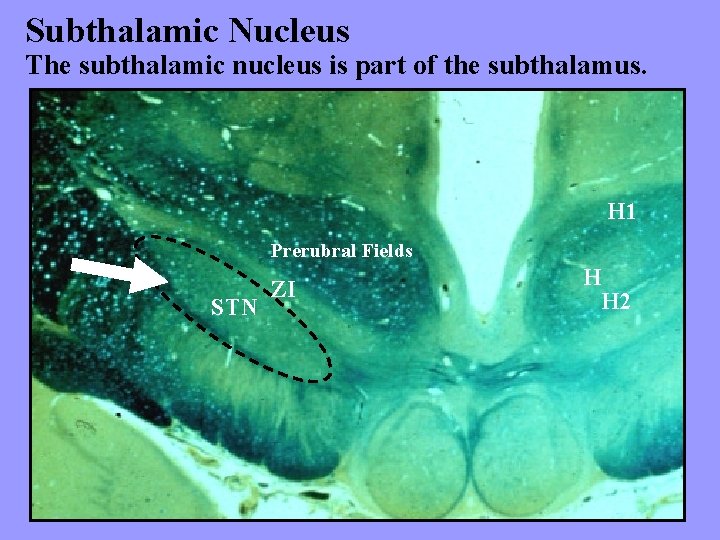 Subthalamic Nucleus The subthalamic nucleus is part of the subthalamus. H 1 Prerubral Fields