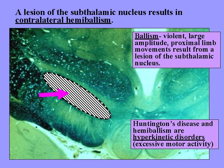 A lesion of the subthalamic nucleus results in contralateral hemiballism. Ballism- violent, large amplitude,