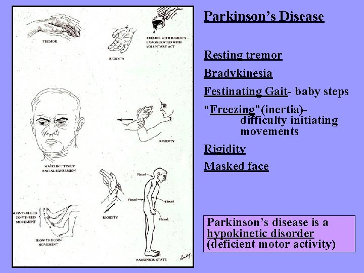 Parkinson’s Disease Resting tremor Bradykinesia Festinating Gait- baby steps “Freezing”(inertia)difficulty initiating movements Rigidity Masked