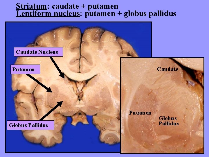 Striatum: caudate + putamen Lentiform nucleus: putamen + globus pallidus Caudate Nucleus Caudate Putamen