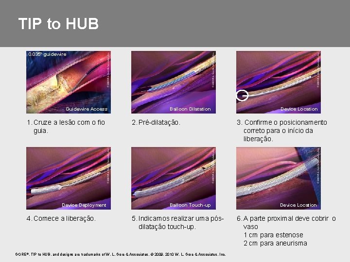 TIP to HUB 0. 035" guidewire Guidewire Access 1. Cruze a lesão com o