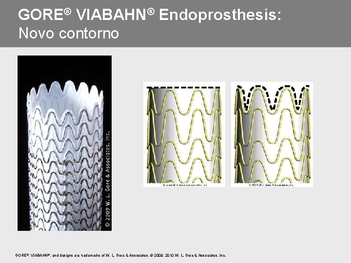 GORE® VIABAHN® Endoprosthesis: Novo contorno GORE®, VIABAHN®, and designs are trademarks of W. L.