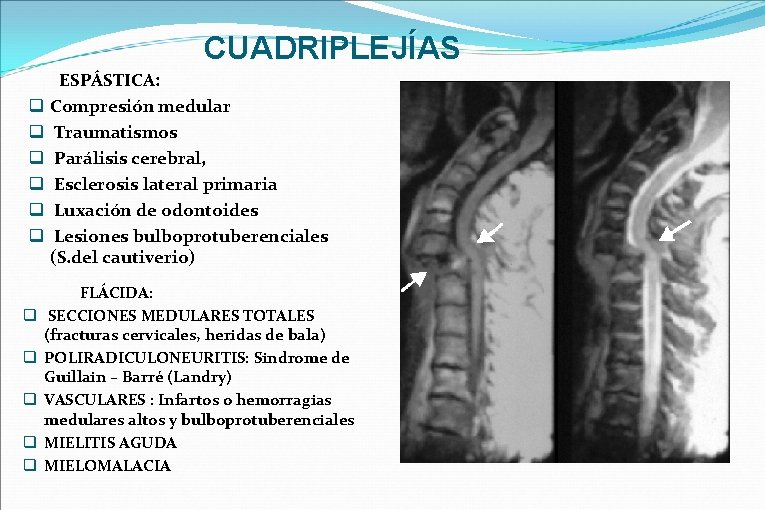 CUADRIPLEJÍAS q q q ESPÁSTICA: Compresión medular Traumatismos Parálisis cerebral, Esclerosis lateral primaria Luxación