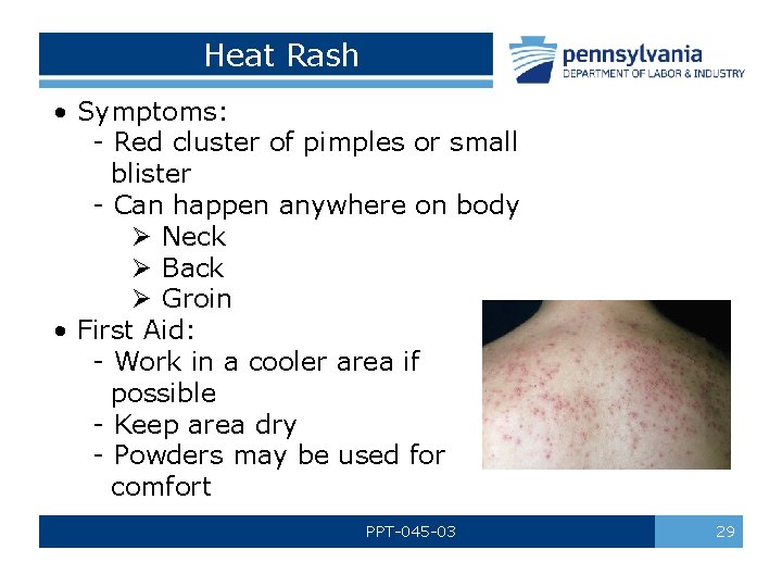 Heat Rash • Symptoms: - Red cluster of pimples or small blister - Can