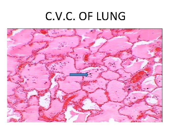 C. V. C. OF LUNG 