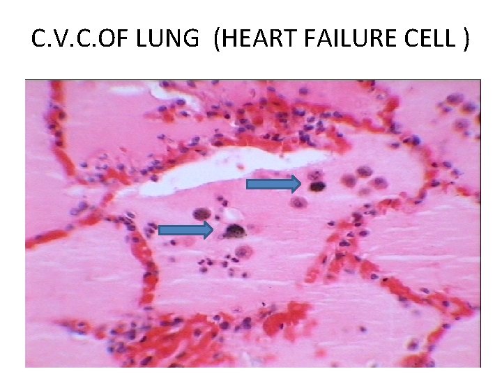 C. V. C. OF LUNG (HEART FAILURE CELL ) 
