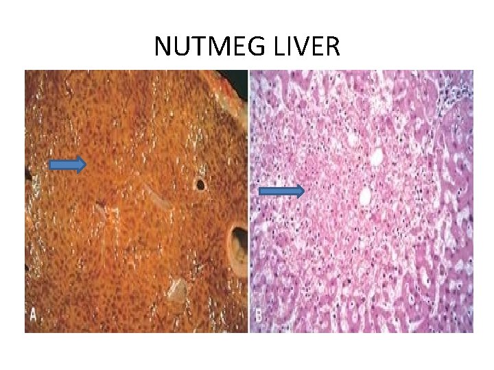 NUTMEG LIVER 