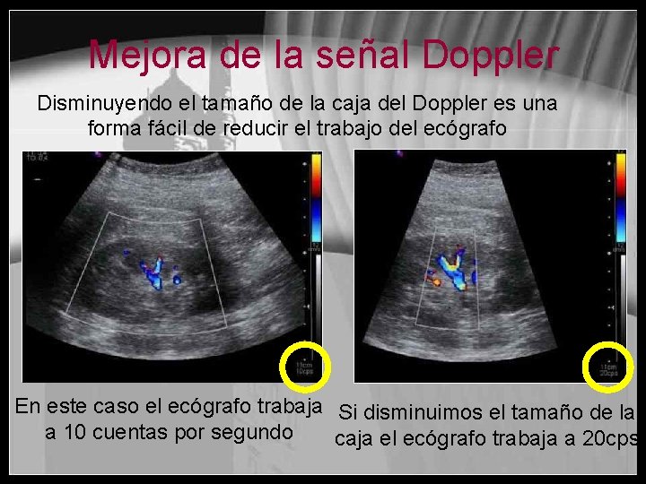 Mejora de la señal Doppler Disminuyendo el tamaño de la caja del Doppler es