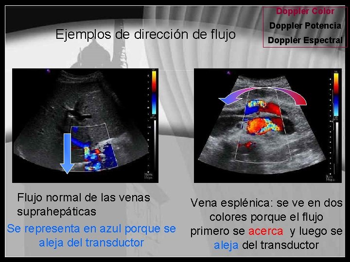 Doppler Color Ejemplos de dirección de flujo Flujo normal de las venas suprahepáticas Se
